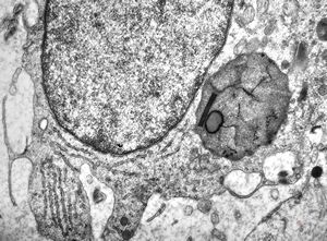 M,9y. | astroblastoma M,9y. | astroblastoma